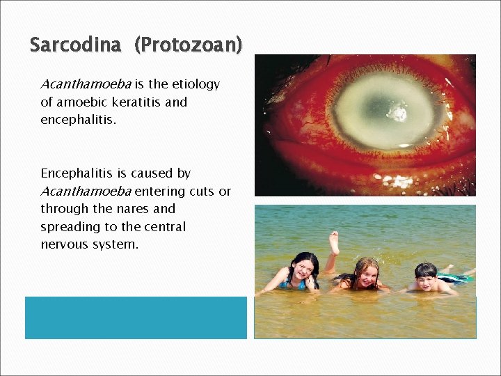 Sarcodina (Protozoan) Acanthamoeba is the etiology of amoebic keratitis and encephalitis. Encephalitis is caused