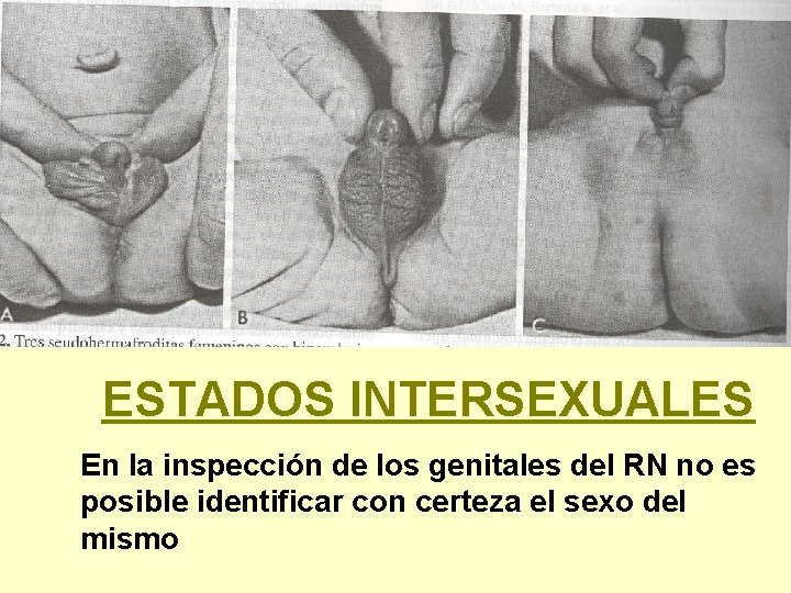 ESTADOS INTERSEXUALES En la inspección de los genitales del RN no es posible identificar