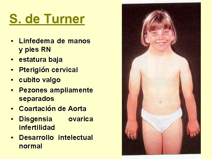 S. de Turner • Linfedema de manos y pies RN • estatura baja •