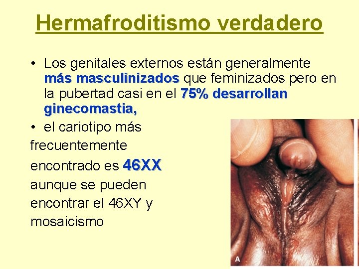 Hermafroditismo verdadero • Los genitales externos están generalmente más masculinizados que feminizados pero en