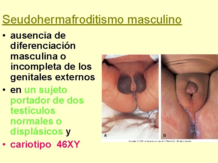 Seudohermafroditismo masculino • ausencia de diferenciación masculina o incompleta de los genitales externos •