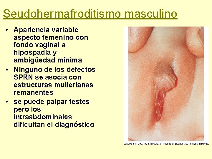 Seudohermafroditismo masculino • Apariencia variable aspecto femenino con fondo vaginal a hipospadia y ambigüedad