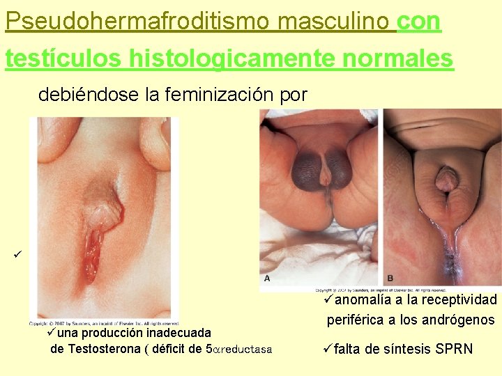 Pseudohermafroditismo masculino con testículos histologicamente normales debiéndose la feminización por ü üuna producción inadecuada