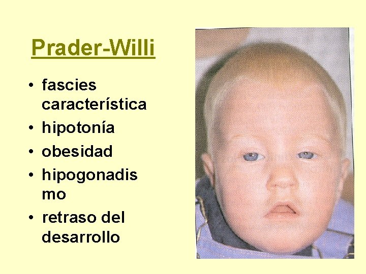 Prader-Willi • fascies característica • hipotonía • obesidad • hipogonadis mo • retraso del