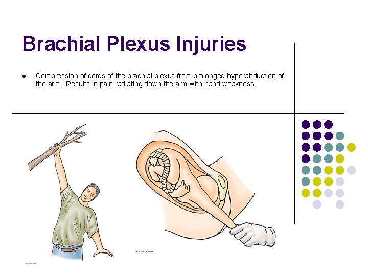 Brachial Plexus Injuries l Compression of cords of the brachial plexus from prolonged hyperabduction