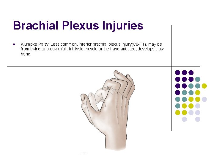 Brachial Plexus Injuries l Klumpke Palsy: Less common, inferior brachial plexus injury(C 8 -T