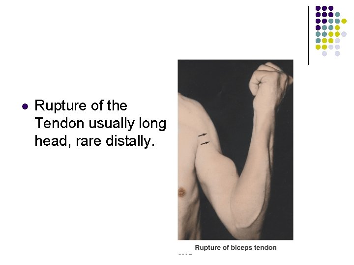 l Rupture of the Tendon usually long head, rare distally. 