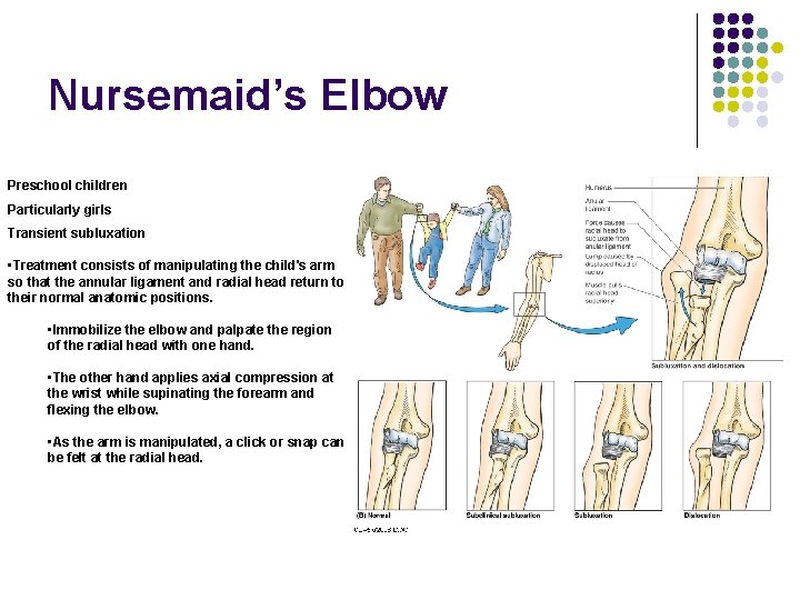 Nursemaid’s Elbow Preschool children Particularly girls Transient subluxation • Treatment consists of manipulating the