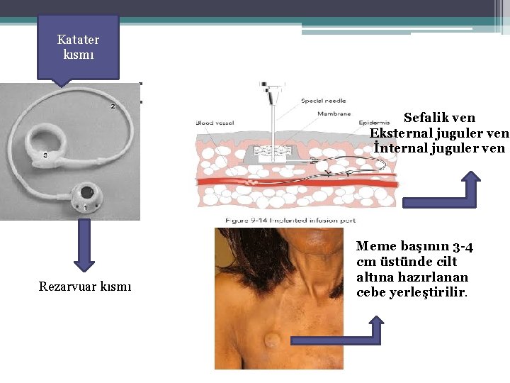 Katater kısmı İMPLANTE PORT Sefalik ven Eksternal juguler ven İnternal juguler ven Rezarvuar kısmı