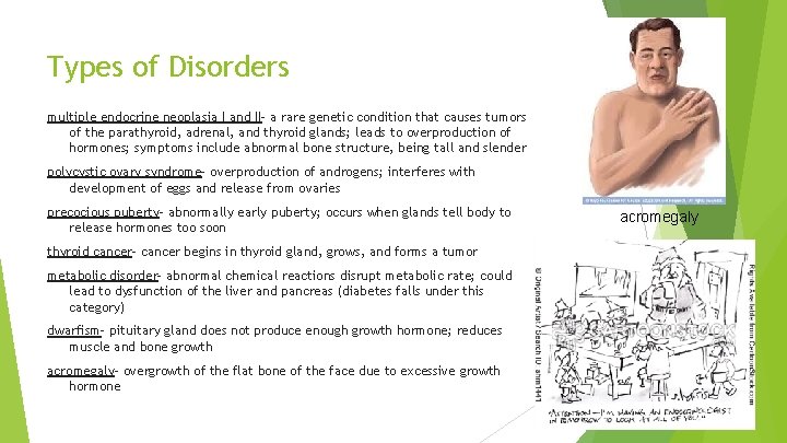 Types of Disorders multiple endocrine neoplasia I and II- a rare genetic condition that