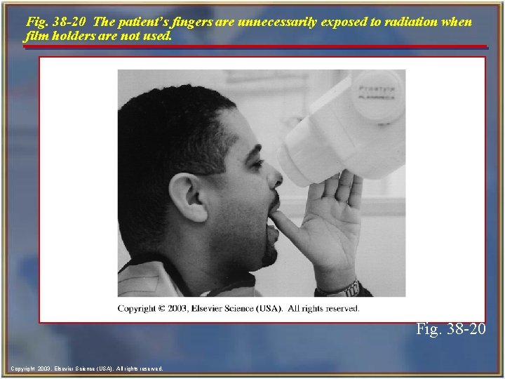 Fig. 38 -20 The patient’s fingers are unnecessarily exposed to radiation when film holders
