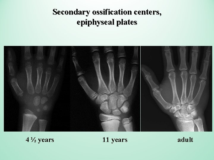 Secondary ossification centers, epiphyseal plates 4 ½ years 11 years adult 