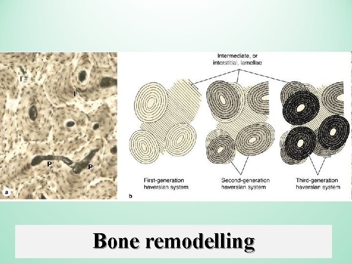 Bone remodelling 