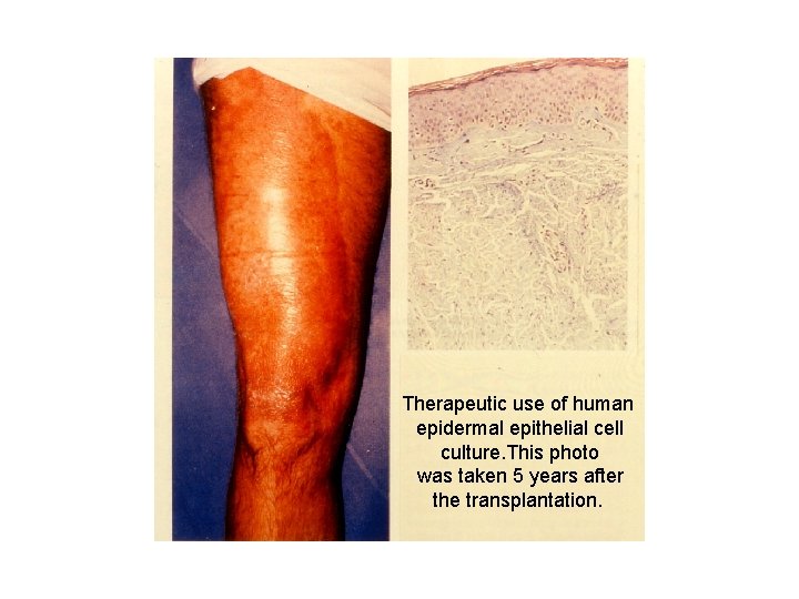 Therapeutic use of human epidermal epithelial cell culture. This photo was taken 5 years