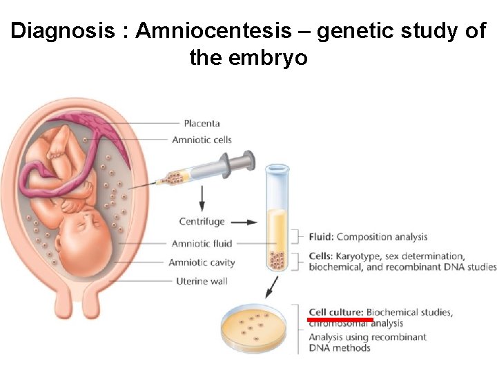 Diagnosis : Amniocentesis – genetic study of the embryo 