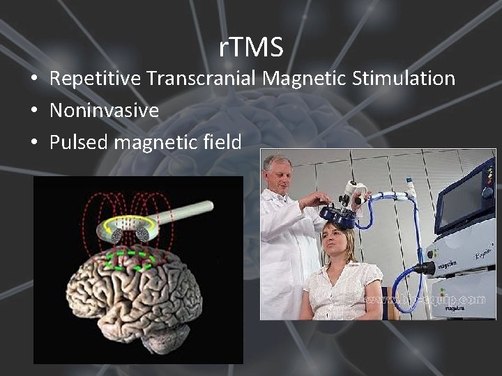 r. TMS • Repetitive Transcranial Magnetic Stimulation • Noninvasive • Pulsed magnetic field 