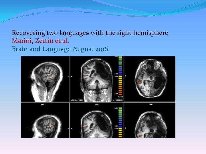 Recovering two languages with the right hemisphere Marini, Zettin et al. Brain and Language