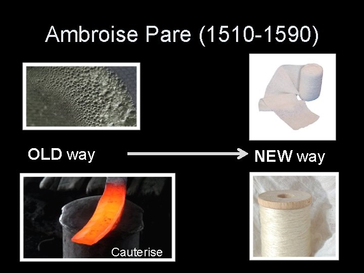 Ambroise Pare (1510 -1590) OLD way NEW way Cauterise 