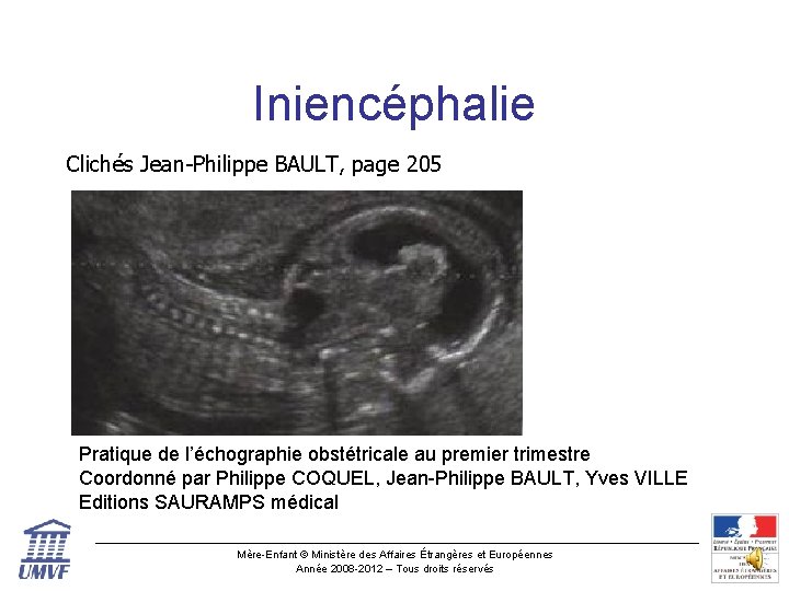 Iniencéphalie Clichés Jean-Philippe BAULT, page 205 Pratique de l’échographie obstétricale au premier trimestre Coordonné