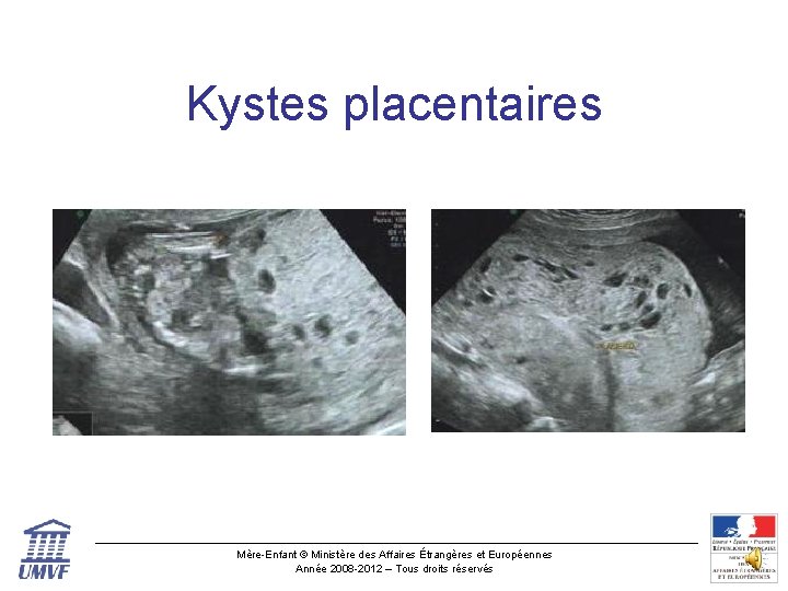 Kystes placentaires Mère-Enfant © Ministère des Affaires Étrangères et Européennes Année 2008 -2012 –
