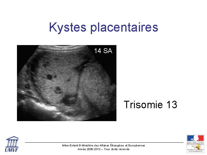 Kystes placentaires 14 SA Trisomie 13 Mère-Enfant © Ministère des Affaires Étrangères et Européennes