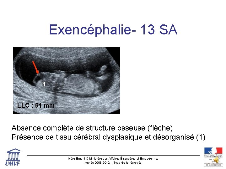 Exencéphalie- 13 SA 1 LLC : 61 mm Absence complète de structure osseuse (flèche)