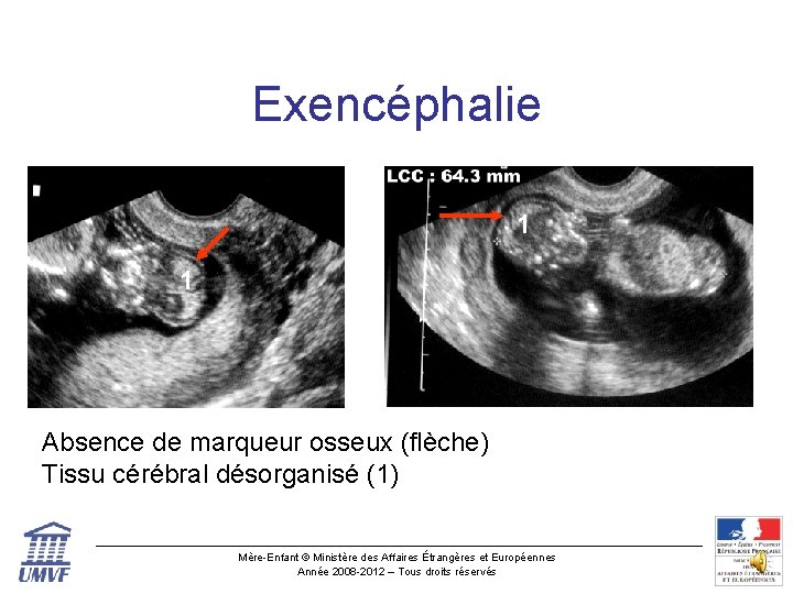 Exencéphalie 1 1 1 Absence de marqueur osseux (flèche) Tissu cérébral désorganisé (1) Mère-Enfant