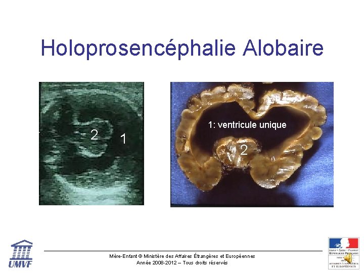 Holoprosencéphalie Alobaire 2 1: ventricule unique 1 2 Mère-Enfant © Ministère des Affaires Étrangères