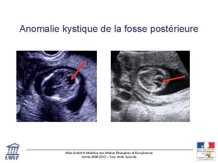 Anomalie kystique de la fosse postérieure Mère-Enfant © Ministère des Affaires Étrangères et Européennes