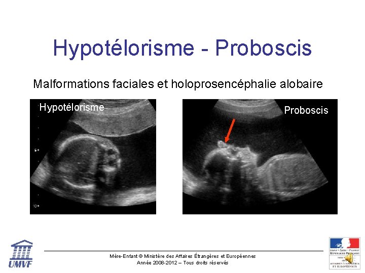 Hypotélorisme - Proboscis Malformations faciales et holoprosencéphalie alobaire Hypotélorisme Proboscis Mère-Enfant © Ministère des