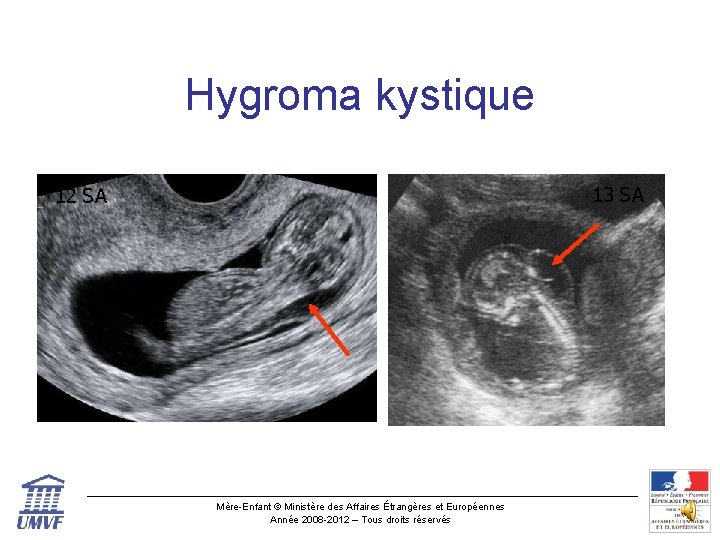 Hygroma kystique 13 SA 12 SA Mère-Enfant © Ministère des Affaires Étrangères et Européennes