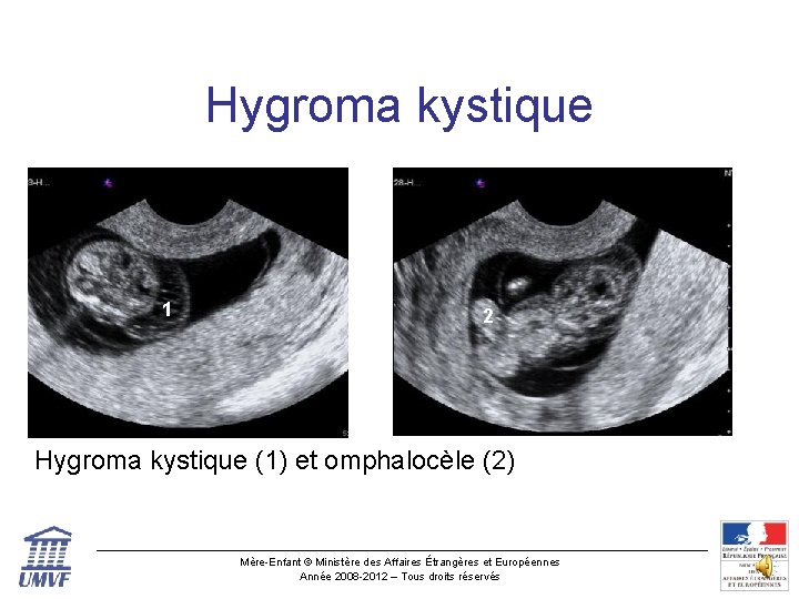 Hygroma kystique 1 2 Hygroma kystique (1) et omphalocèle (2) Mère-Enfant © Ministère des
