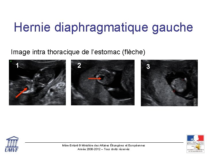 Hernie diaphragmatique gauche Image intra thoracique de l’estomac (flèche) 1 2 Mère-Enfant © Ministère