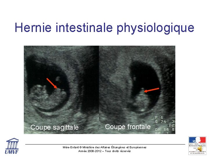 Hernie intestinale physiologique Coupe sagittale Coupe frontale Mère-Enfant © Ministère des Affaires Étrangères et