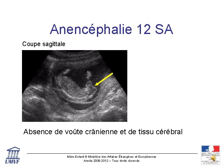 Anencéphalie 12 SA Coupe sagittale Absence de voûte crânienne et de tissu cérébral Mère-Enfant