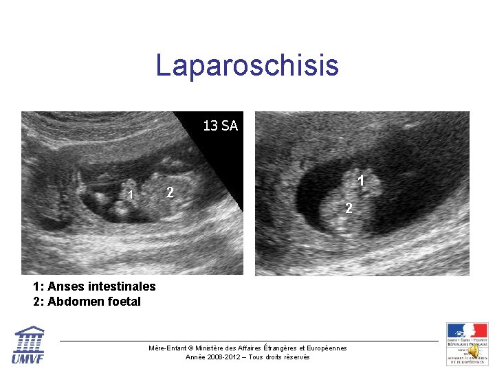Laparoschisis 13 SA 2 1 1 2 1: Anses intestinales 2: Abdomen foetal Mère-Enfant
