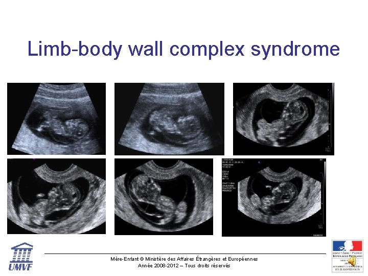 Limb-body wall complex syndrome Mère-Enfant © Ministère des Affaires Étrangères et Européennes Année 2008