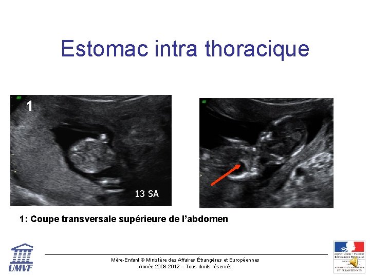 Estomac intra thoracique 1 13 SA 1: Coupe transversale supérieure de l’abdomen Mère-Enfant ©