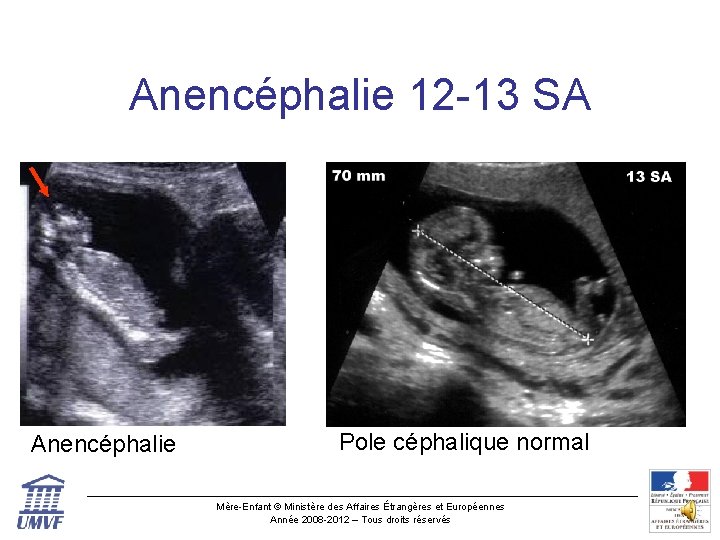 Anencéphalie 12 -13 SA Anencéphalie Pole céphalique normal Mère-Enfant © Ministère des Affaires Étrangères