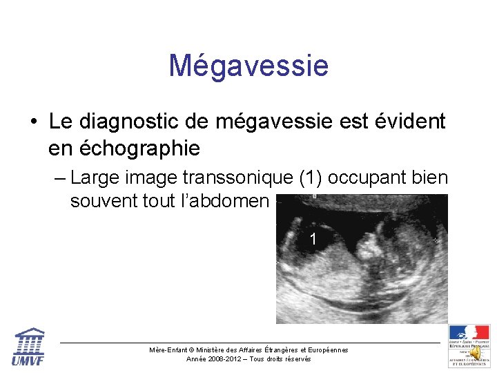 Mégavessie • Le diagnostic de mégavessie est évident en échographie – Large image transsonique