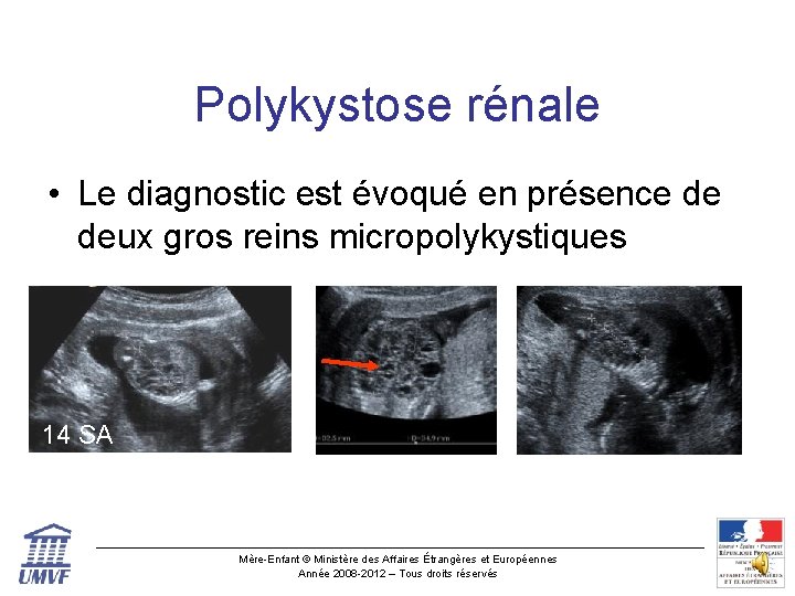 Polykystose rénale • Le diagnostic est évoqué en présence de deux gros reins micropolykystiques