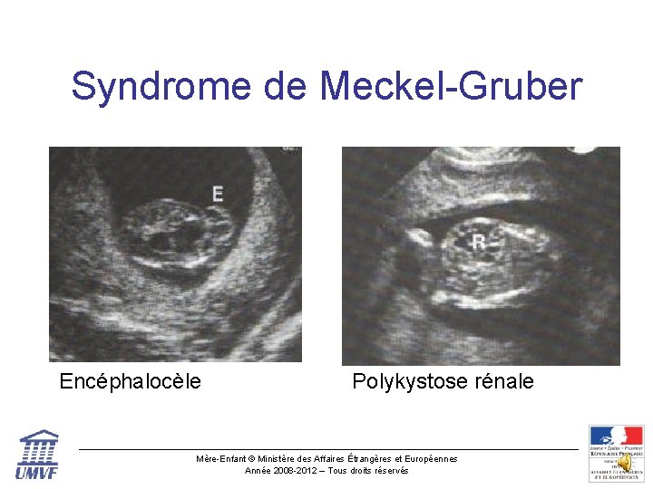 Syndrome de Meckel-Gruber Encéphalocèle Polykystose rénale Mère-Enfant © Ministère des Affaires Étrangères et Européennes