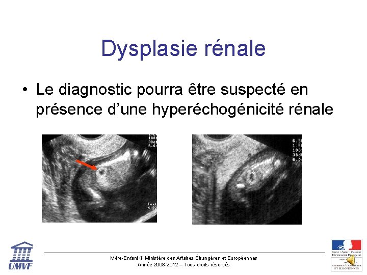 Dysplasie rénale • Le diagnostic pourra être suspecté en présence d’une hyperéchogénicité rénale Mère-Enfant