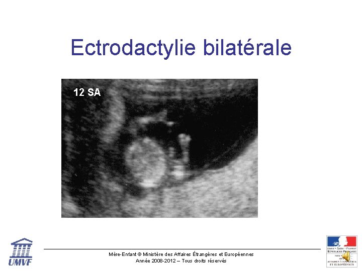 Ectrodactylie bilatérale 12 SA Mère-Enfant © Ministère des Affaires Étrangères et Européennes Année 2008