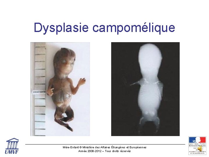 Dysplasie campomélique Mère-Enfant © Ministère des Affaires Étrangères et Européennes Année 2008 -2012 –
