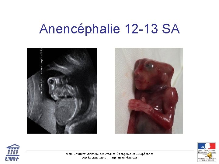 Anencéphalie 12 -13 SA Mère-Enfant © Ministère des Affaires Étrangères et Européennes Année 2008