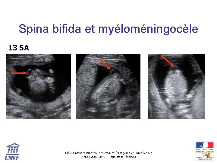 Spina bifida et myéloméningocèle 13 SA Mère-Enfant © Ministère des Affaires Étrangères et Européennes