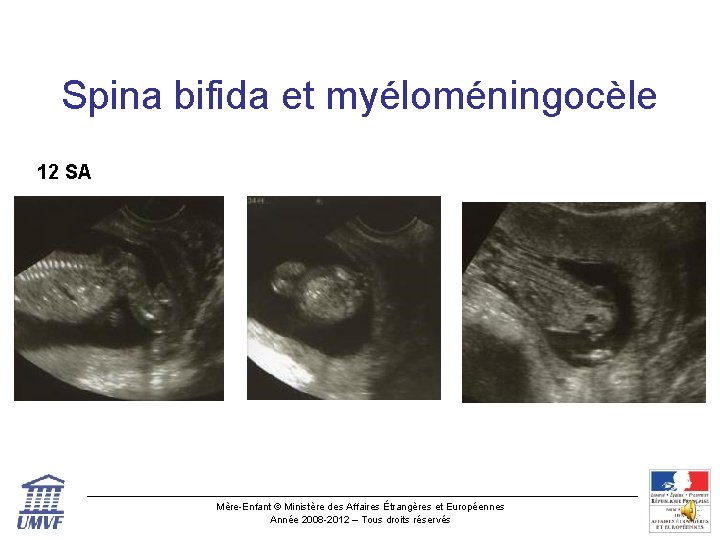 Spina bifida et myéloméningocèle 12 SA Mère-Enfant © Ministère des Affaires Étrangères et Européennes