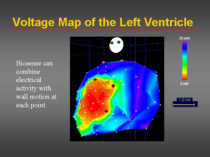 Voltage Map of the Left Ventricle 25 m. V Biosense can combine electrical activity