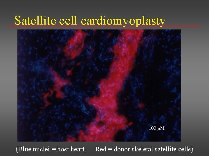 Satellite cell cardiomyoplasty (Blue nuclei = host heart; Red = donor skeletal satellite cells)